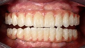 son şirket davası hakkında Müşteri Davası. 4 boyutlu zirkonya bloğu.