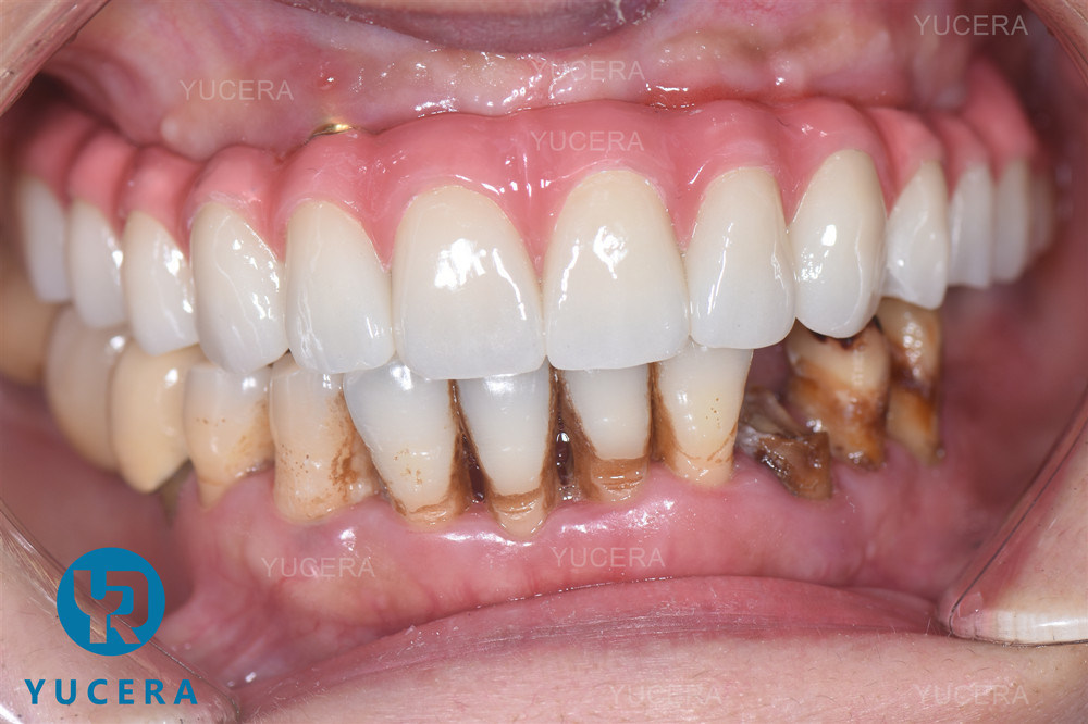 3D Plus Multilayer 43% -57% 6 Layers 3D Zirconia Dental Block Disc for CAD CAM 95mm System