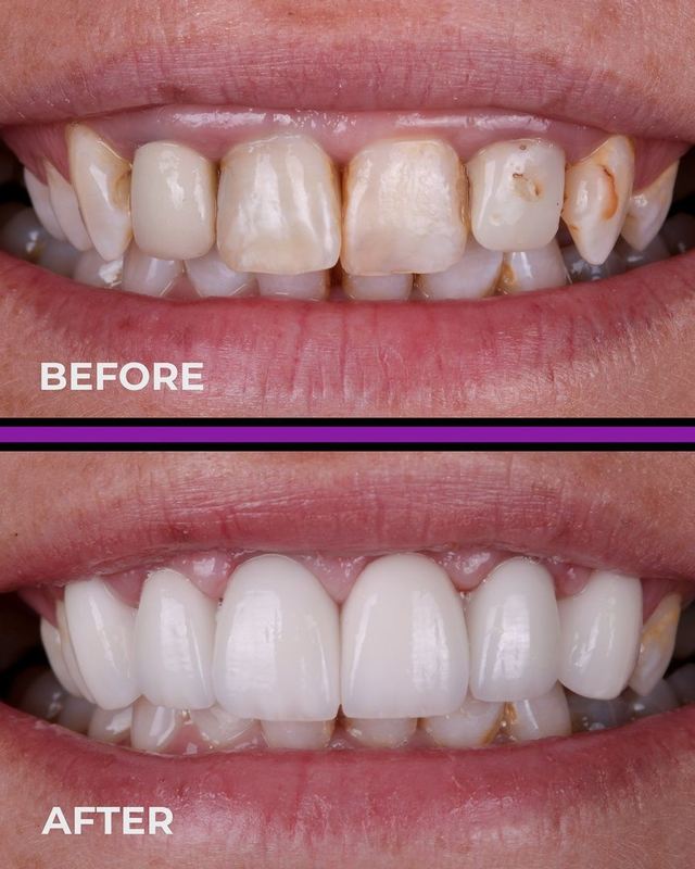 YUCERA 1200MPa 98 HT Dental Zirconia Blocks Dental Consumable Pre Shaded Zirconia Dental Zirconia  Block