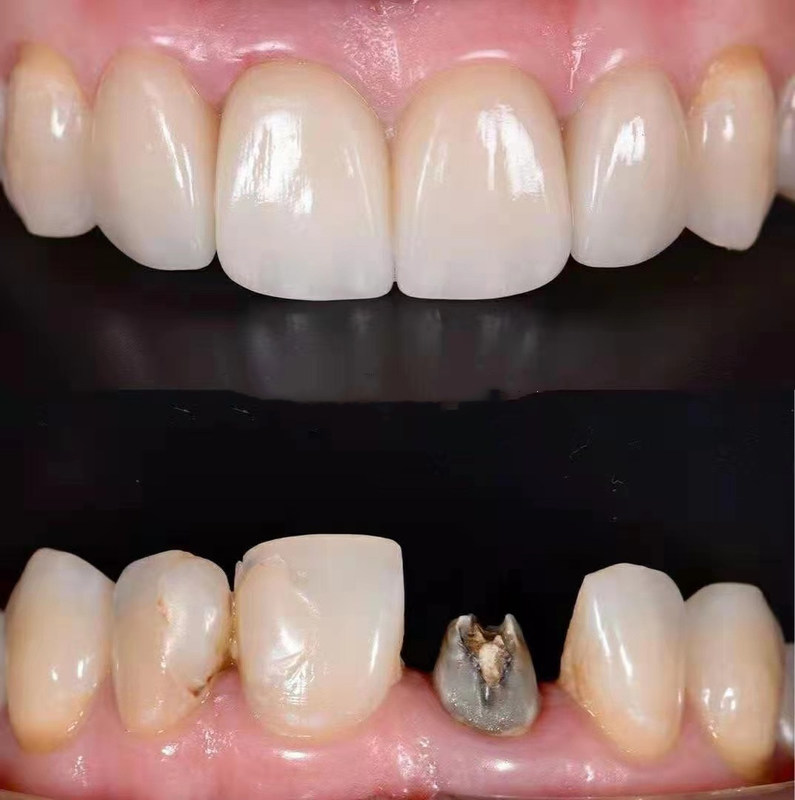 YUCERA 3D Plus Multicapa Superventas De Alta Resistencia 3D Multicapa Pre-Shades Zirconia Bloque Para Lab Dental Sistema CAD CAM