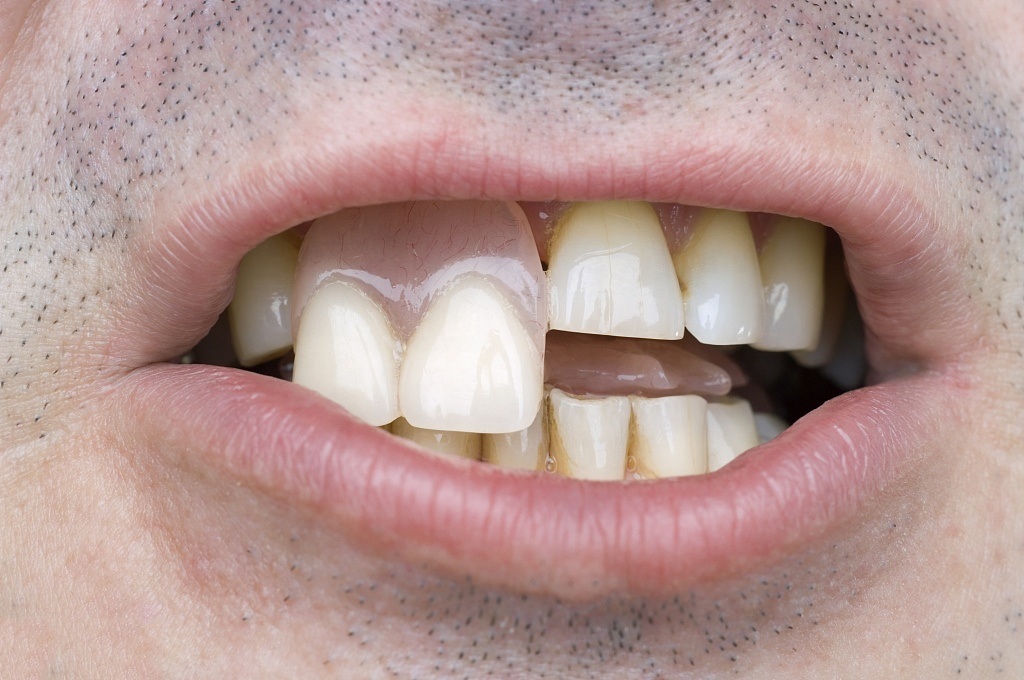High Quality and Affordable Yucera Zirconia Blocks Dental Lab SHT Multilayer Zirconia Blocks Price