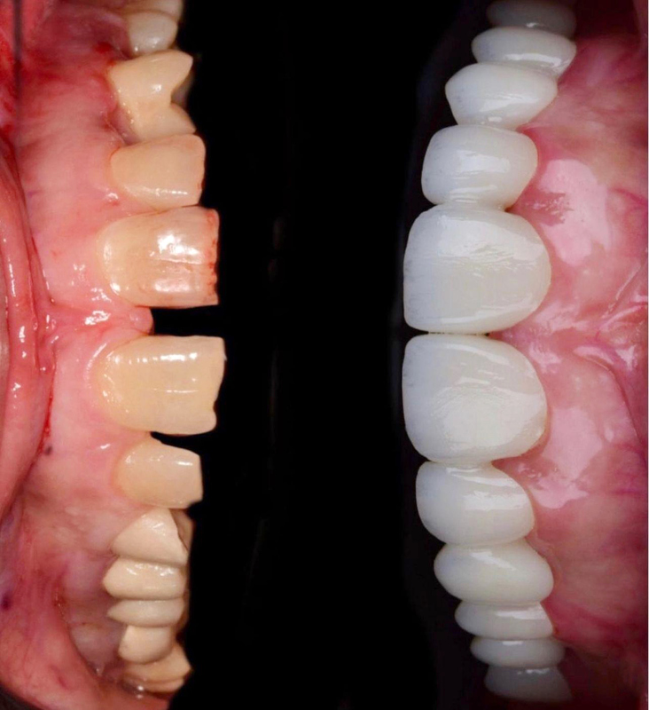43%-57% Translucency 700-1200 MPa Bending Strength YUCERA Dental 98mm Open System CAD/CAM 4D Pro Multilayer Zirconia Block
