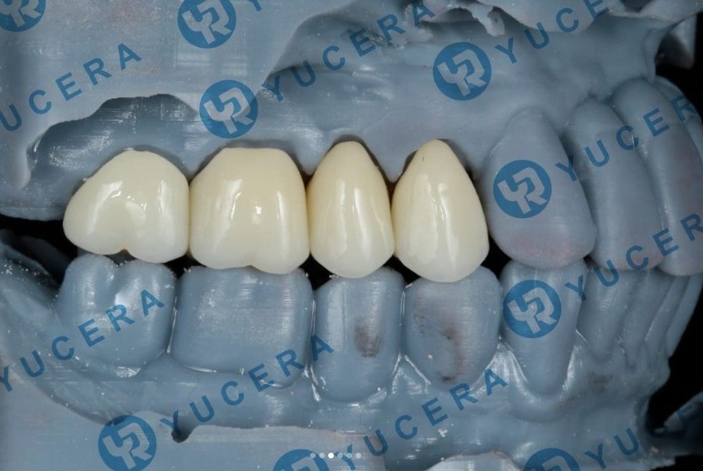 Yucera Cad Cam 4D Pro Multilayer Super Zir 98 Open System Crown Dental Laboratory Dental Zirconia Block