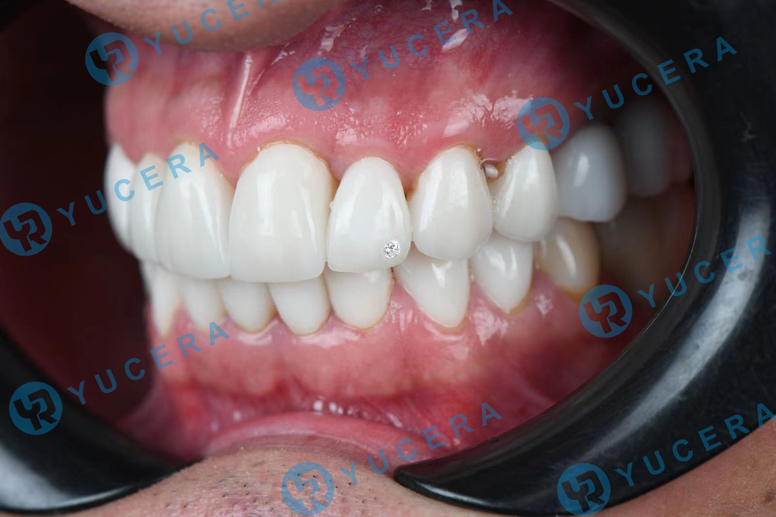 Yucera Cad Cam 4D Pro Multilayer Super Zir 98 Open System Crown Dental Laboratory Dental Zirconia Block