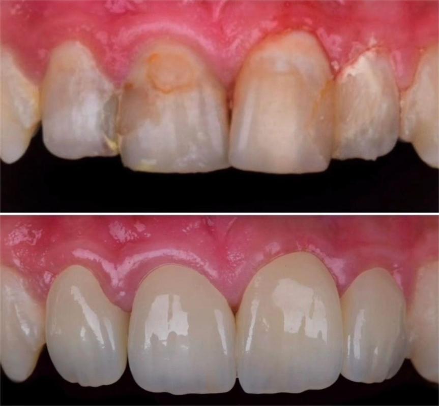 Yucera 4D Plus Multilayer Zirconia Block Explore Dental Material with CE ISO CAD CAM 98mm Open System