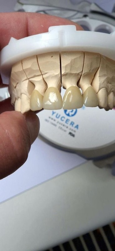 Yucera ST color 3D Multilayer Zirconia Block - Precision - Engineered for CAD/CAM Dentistry